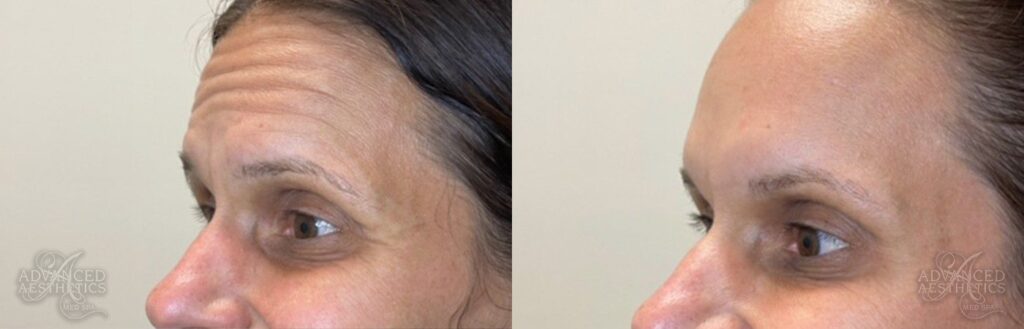 advancedaesthetics_beforeandafters__Botox-Patient4