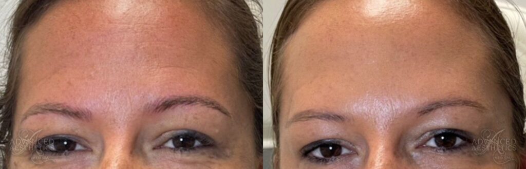 advancedaesthetics_beforeandafters__Botox-Patient6