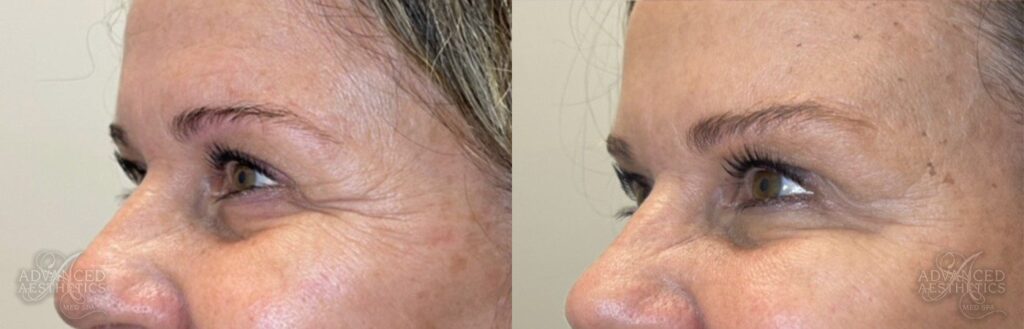 advancedaesthetics_beforeandafters__Botox-Patient7